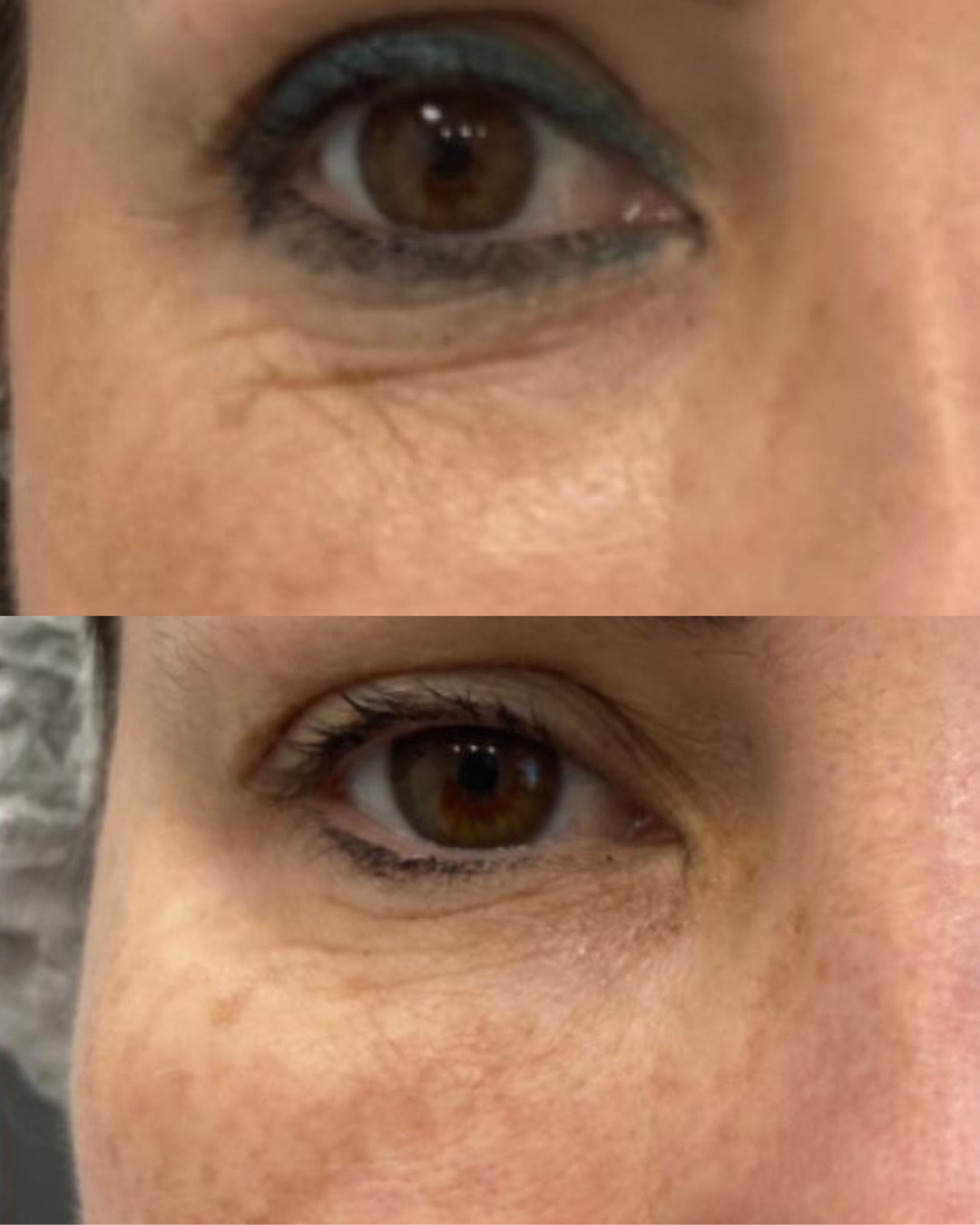 Resultado LIFT Bio Cell — Área periocular