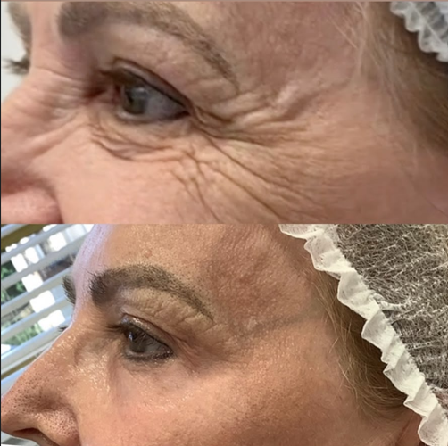 Resultado LIFT Bio Cell — Contorno dos olhos