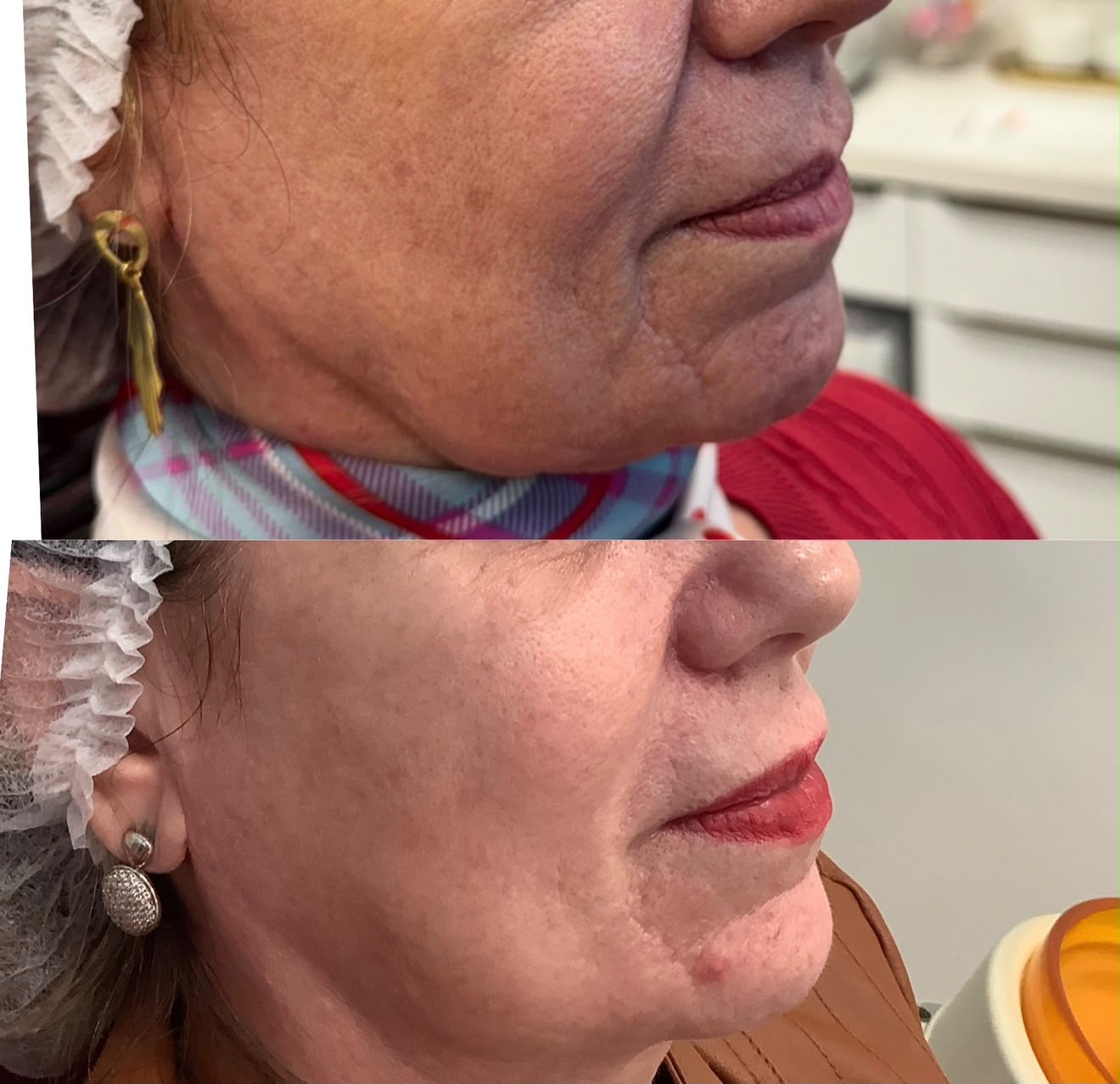 Resultado LIFT Bio Cell — Terço inferior do rosto